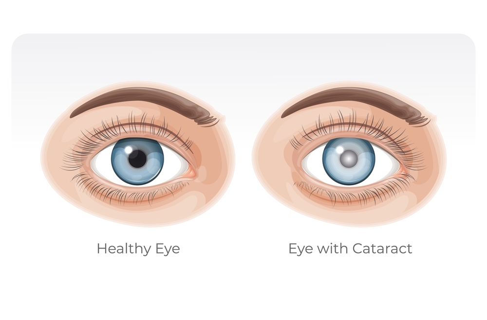 eyes with catract